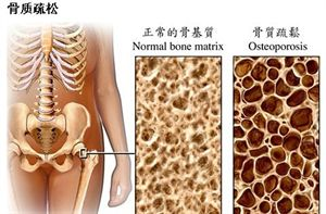 骨質疏松 骨質疏松