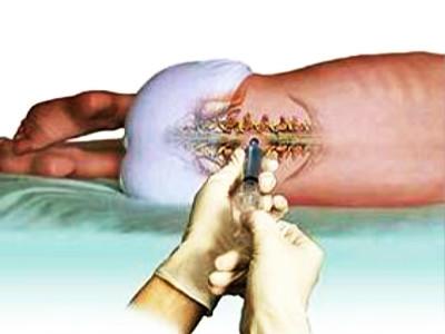 腰椎手術治療 腰椎手術治療