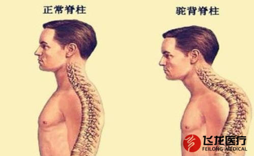 脊柱健康,不向生活“低頭” 脊柱健康,不向生活“低頭”