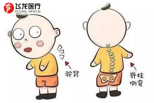 年輕人脊柱側彎 年輕人脊柱側彎