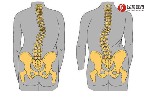 脊柱側彎 脊柱側彎