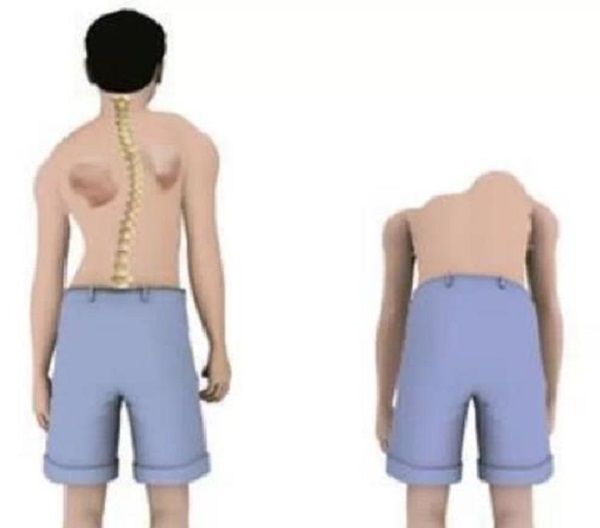 脊柱康復 脊柱康復