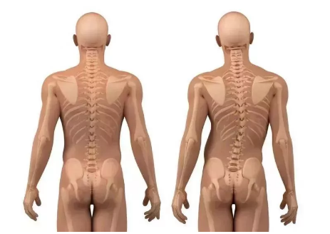 脊柱側彎 脊柱側彎