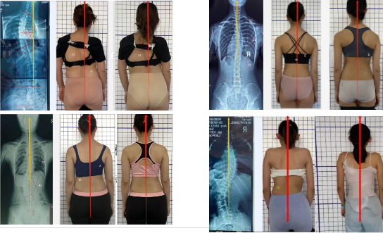脊柱側彎治療 脊柱側彎治療