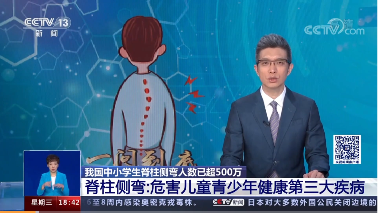 青少年脊柱側彎現狀堪憂 青少年脊柱側彎現狀堪憂