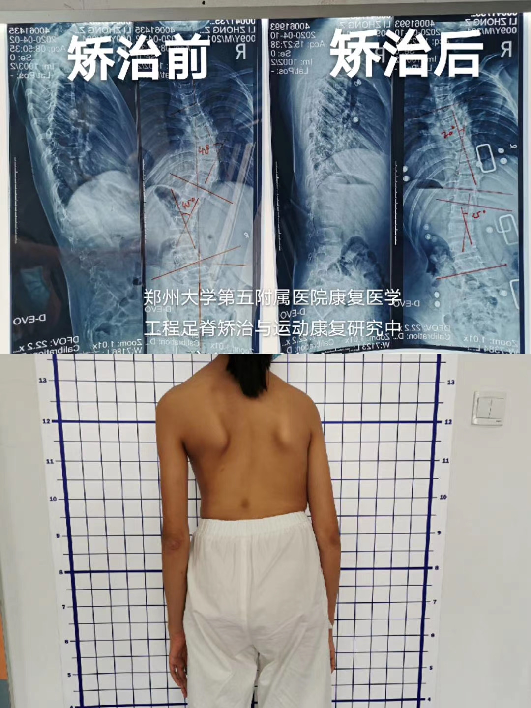 外星艙脊柱減壓脊柱側彎治療效果 外星艙脊柱減壓脊柱側彎治療效果